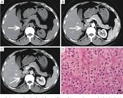 Mri is superior to ct in the evaluation of cardiac masses. Ct And Mri Of Adrenal Gland Pathologies Semantic Scholar