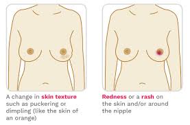 Breast cancer signs and symptoms. Signs Of Breast Cancer How To Check Your Breasts