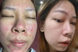 ⚜️Liệu trình mới giúp giảm mụn chỉ sau...