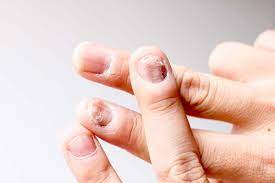 Nagelpilz Erkennen Und Behandeln Bilder Behandlung Hausmittel Vorbeugung