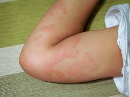 Symptoms generally resolve within two hours but can linger for days. Signs You Re Having An Allergic Reaction And When To See The Doctor