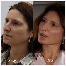 Maybe you would like to learn more about one of these? Thread Face Lift London Facial Sculpting Thread Lift London