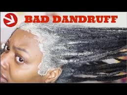 How To Permanently Cure Itchy Scalp Rid Of Dandruff Youtube