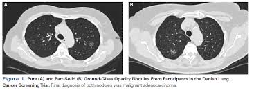Each has its own strengths. Ground Glass Opacity Lung Nodules In The Era Of Lung Cancer Ct Screening Radiology Pathology And Clinical Management