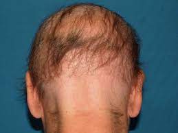 Heavy metal poisoning thallium or arsenic poisoning. Celiac Disease Gluten Sensitivity And Skin Issues