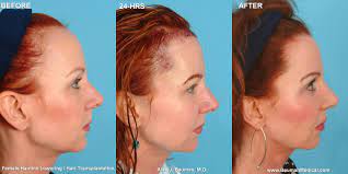 It is not uncommon for this to be the catalyst to additional changes with hair in the coming months either. Plastic Surgery Related Hair Loss Bauman Medical