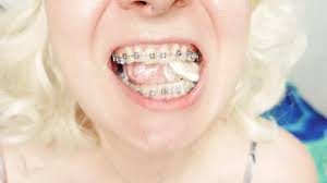 Braces Fetish Close up Video Mukbang: MILF Porn by fansly