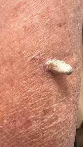 Image result for cornu cutaneum)