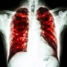 Pneumonia este o inflamatie a tesutului pulmonar adica a portiunii inferioare a cailor respiratorii, formate din bronsiile cele mai mici si alveolele pulmonare. Pneumonia InterstiÅ£ialÄƒ La Copii Simptome È™i Tratament