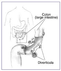 Image result for Diverticulitis