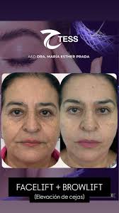 FACELIFT + BROWLIFT, (Elevación de cejas)