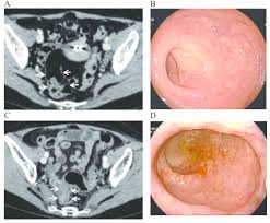 Image result for Radiation Colitis
