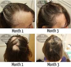 You can't give it to others. Alopecia Hair Loss Nearly Ruins Woman S Wedding Day