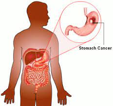 In more advanced stages, symptoms of stomach cancer can include: Stomach Cancer Treatment From Best Hospitals In India