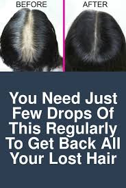 The great news is that with proper diet and supplementation, this type of hair loss is reversible.. You Need Just Few Drops Of This Regularly To Get Back All Your Lost Hair Step 1 Hair Pack You Will Need 3 Sp Lost Hair Thicken Hair Naturally Scalp Hair Loss