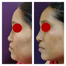 Although the cost of the nose reshaping surgery is largely dependent on the complexity of the surgery, it will cost you about rs. Nose Surgery Cost Bangalore Leading Nose Reshaping Rhinoplasty Surgeon In India