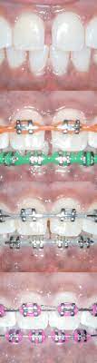 Can braces be used to close gaps? Gaps Between Teeth Before And After Braces Viechnicki Orthodontics