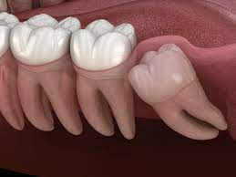 How much does removal cost? Wisdom Teeth Removal Surgery Preparation And Recovery