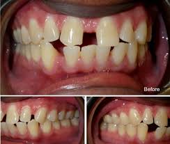 Some people are born with a natural gap in their front teeth, also known as a diastema. Everything You Need To Know About Spaces Gaps Between Teeth