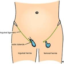 Inguinal Hernia Corewalking