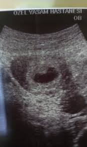 Leere Fruchthohle Schwangerschaftsgruppe Babycenter