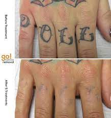 Part 1 Of 2 Tune In Tomorrow To See The Other Set Of Knuckles Massive Fading After 5 Treatments For This Client U Tattoos Finger Tattoos Finger Tattoos Fade
