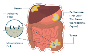 Some doctors may order a pet scan. Peritoneal Mesothelioma Treatment Prognosis Diagnosis