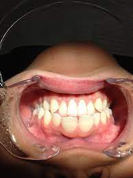 Is Tooth Decay A Symptom Of Thyroid Disease