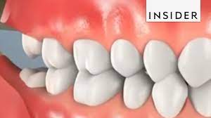An impacted wisdom tooth can cause serious health issues. Why Do We Remove Wisdom Teeth Youtube