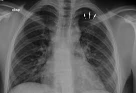 Image result for Pulmonary Intoxicant