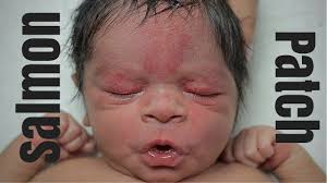The patches can range from white to pink and from tan to dark. Pityriasis Alba Whitepatch Pityriasisalba Youtube