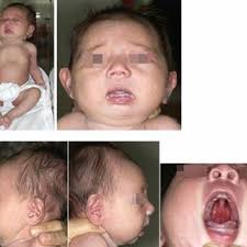 PDF) Pierre Robin sequence: Challenges in the evaluation, management and  the role of early distraction osteogenesis