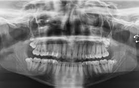 Impacted wisdom teeth can cause several problems in the mouth: Impacted Wisdom Tooth Extraction What Does It Mean