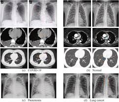 For individuals that already have a chronic lung disease, those symptoms may worsen. Deep Chest Multi Classification Deep Learning Model For Diagnosing Covid 19 Pneumonia And Lung Cancer Chest Diseases Sciencedirect