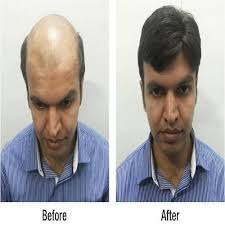 Buckhead hair restoration is atlanta's top hair restoration choice for prp therapy and neograft hair transplantation. Black Men Hair Patch Wigs For Personal Rs 13000 Piece Veronica Hair Replacement Solution Id 20309130548
