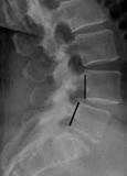 Image result for icd 10 code for acquired spondylolisthesis
