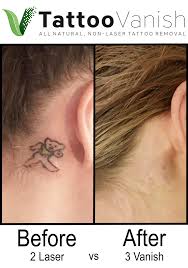 With the 5 points, or perhaps you want even more points and to come up with your very own variation of the star, it is an easy and applicable piece to fit in small places such as behind the ear. Tattoo Removal Twin Cities All Natural Non Laser Tattoo Removal