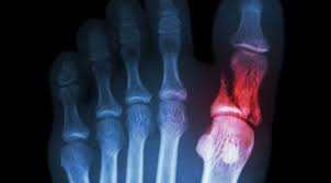 Here S What Happens When You Don T Treat A Broken Toe Superior Foot Ankle Care Center