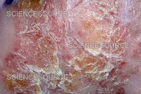 Image result for pompholyx soles of feet