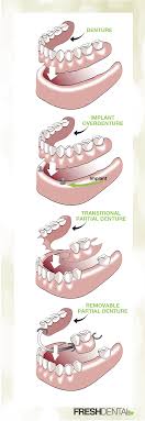 Dental insurance can help manage the cost of dentures. Dentures Fresh Dental Nc Your Local Dentist