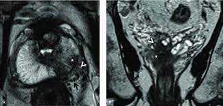 01.08.2015 · i was staged at t3a in november. Prostate Cancer Demonstrating Extra Prostatic Disease Tnm 8th Edition Download Scientific Diagram