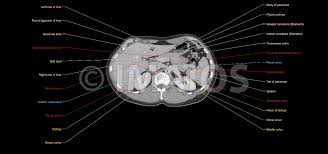 It is the most complete reference of human anatomy available on web, ipad, iphone and android devices. Abdomen And Pelvis Ct