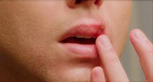 There are two types of herpes simplex virus: What You Need To Know About Cold Sores