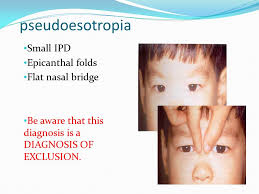 My 19 m.o has epicanthal folds and flat nasal bridge but no other physical signs of ds. Strabismus For 5 Th Yr Medical Students Mutaz Gharaibeh Md Ppt Download
