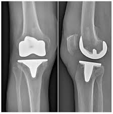 Un succès d'équipe!» conférence, dr jacques vallotton, avec julien rappaz et david conte. La Prothese Totale Du Genou