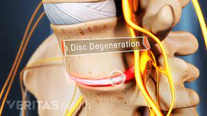 Lumbar Degenerative Disc Disease Ddd
