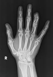Central Polysyndactyly Radiology Case Radiopaedia Org Radiology Radiology Imaging Radiology Humor