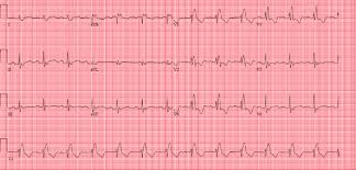 The ekg is used to determine heart rate, heart rhythm and other information regarding the heart's condition. Standard Ekg Fokus Ekg