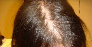Beberapa hal boleh menyebabkan rambut gugur berlebihan. Gejala Kebotakan Pada Wanita Korankaltim Com