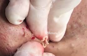 A bartholin's cyst or abscess typically only develops on one of the two glands. Satisfying Acne Squeezing And Popping Joyscribe